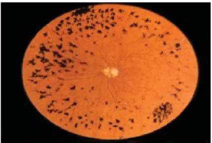 Gambar 7. Fundus picture in retinitis pigmentosa