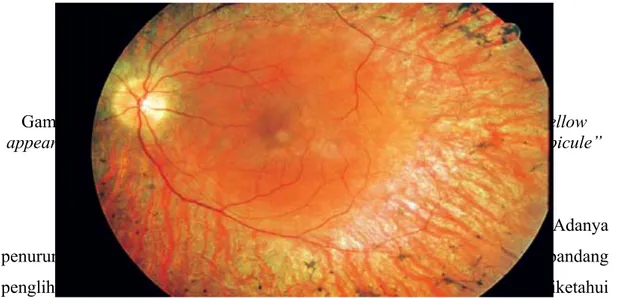 Gambar 12. Karakteristik tanda adanya  narrowed retinal vessels, waxy yellow  appearance of the optic disk due to atrophy of the optic nerve, and “bone-spicule” 