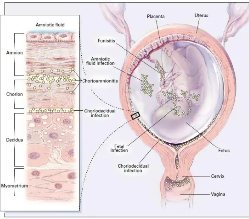 Gambar 1. Tempat potensial terjadinya infeksi bakteri intrauterin 