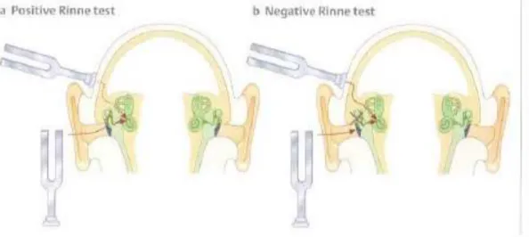 Gambar 2.8: Tes Rinne