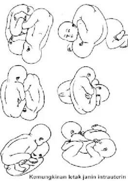 Gambar : kemungkinan letak / inter intrauterin pada kehamilan kembar  Jika anak pertama le