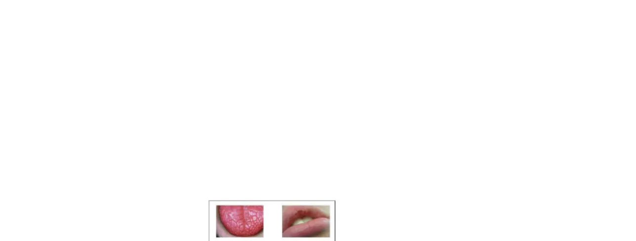 Gambar 1.Tanda  Xerostomia:  A.  lidah  berfisura  dan  berlobul  ;  B.  Bibir  kering  dan  pecah-pecah