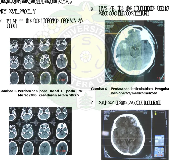 Gambar 1. Perdarahan pons, Head CT pada  26  Maret 2006, kesadaran setara SKG 5 