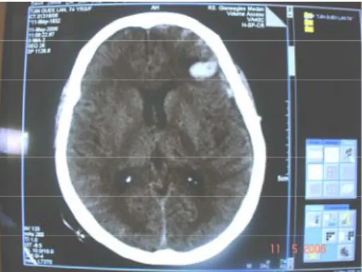 Gambar 5 &amp; 6. Perdarahan  intracerebral  frontal     kiri, Pengobatan non-operatif/ 