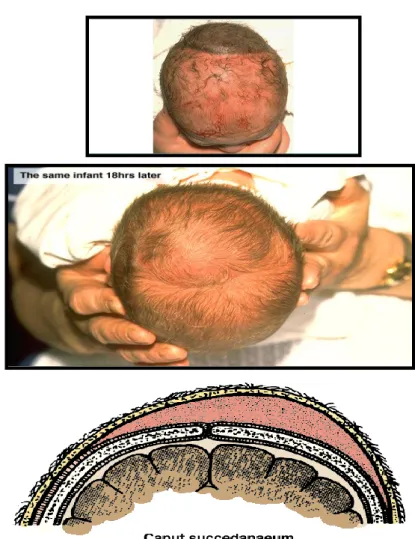 Gambar 5 :  Caput Succedaneum  