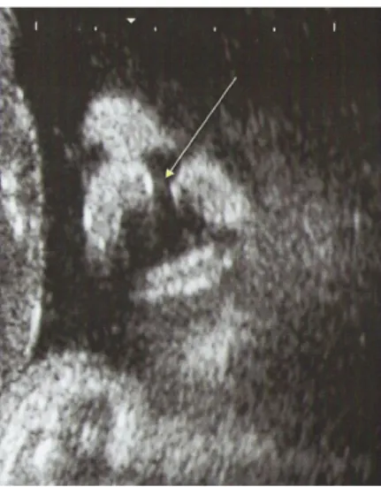 Gambar  Antenatal diagnosis pada labioschizis