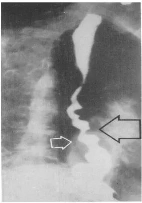 Gambar 2.11 Striktur esofagus 