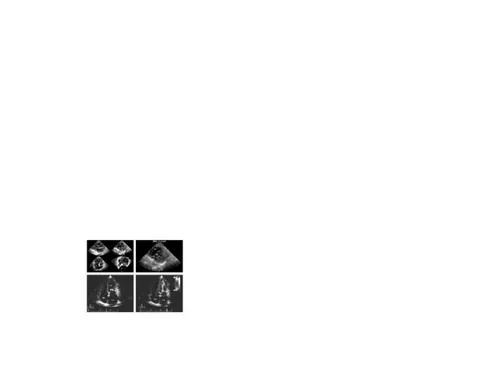 Gambar 7. Struktur katup mitral pada stenosis mitral dengan transtorakal ekokardiografi