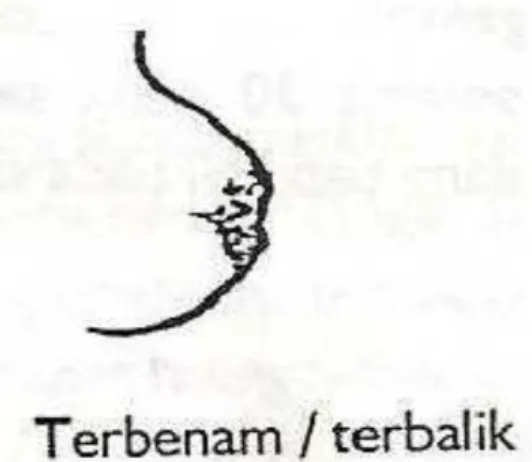 Gambar 5. Bentuk puting susu terbenam/ terbalik 