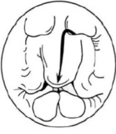 Gambar 7. Tipe 3 Laringomalasia, yaitu melekuknya epiglotis ke  arah posterior  10