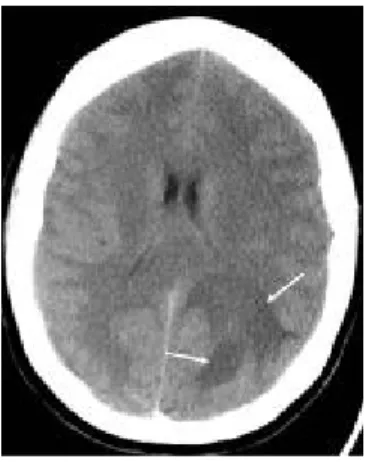 Gambar 2.2. Early cerebritis pada CT-Scan  (Sumber: http://emedicine.medscape.com)