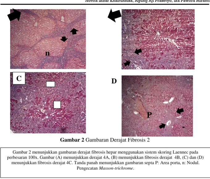Gambar 2 Gambaran Derajat Fibrosis 2 