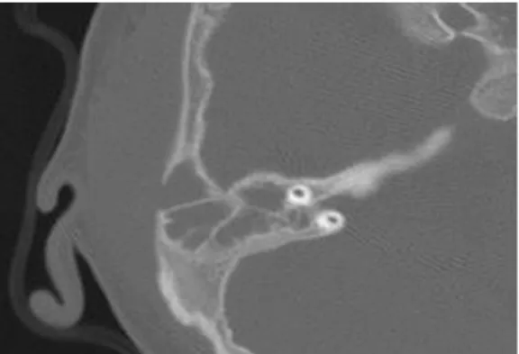 Gambar 3. Gambaran CT-scan menunjukkan abses retroaurikula/periaurikula yang menutupi dehiscence korteks mastoid 5