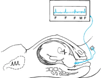 Gambar 5. Gambaran skematik pemantauan internal dimana elektroda bipolar terpasang pada kulit kepala janin, untuk mendeteksi kompleks QRS ( F), juga menunjukkan denyut jantung ibu ( M) 8
