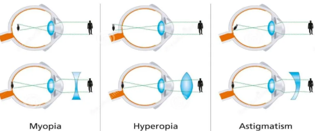 Gambar 1. Skematik jatuhnya bayangan pada penderita ametropia 