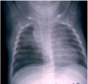 Gambar 8. Tuberkulosis primer serta efusi pleura kanan 