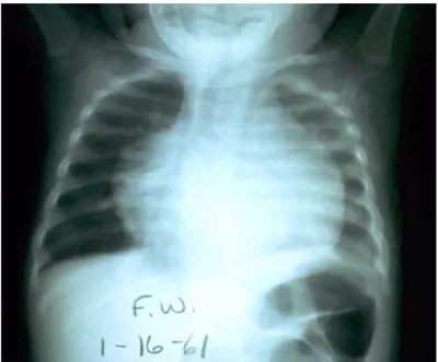 Gambar 12. Tuberkulosis milier dengan kavitas di paru kanan lobus bawah. 
