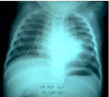 Gambar 14. Tuberkulosis milier pada remaja. 