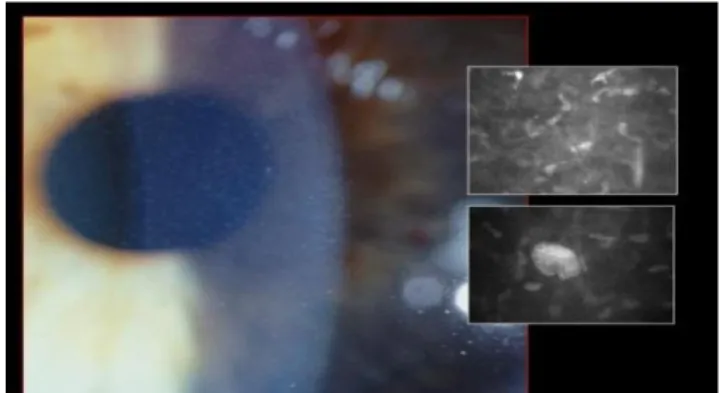 Gambar 15. Kornea berisi bintik kecil yang keruh. Penampilan kornea dengan biomicroscopy  slit lamp (gambar kiri) dan mikroskop confocal (gambar kanan) 