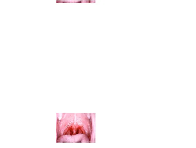 Gambar 2.4. Streptococcal Pharyngitis
