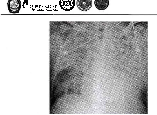 Gambar 2.Diffuse konsolidasi Pneumonia pada Acute Respiratory Distress Sl,ndrome(ARDS)