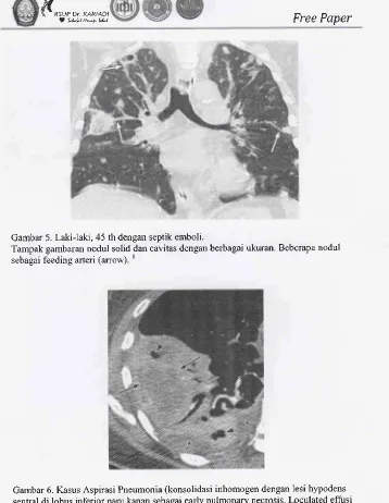 Gambar 6. Kasus Aspirasi Pneumonia (konsolidasi inhomogen dengan lesi hypodenssentral di lobus inferior paru kanan sebagai early pulmonary necrosis
