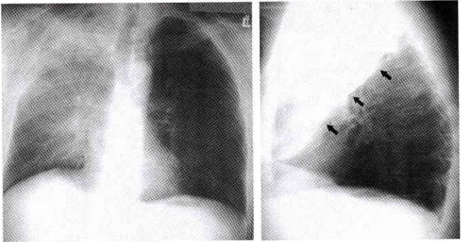 Gambar 8. Kombinasi atelektasis lobus superior dan inferior paru kanans pada setengah atas paru kanan dengan perihillar terangkat dans jantung ; gambar S.b.Posisi lateral ditunjukkan di anterior dan-uyor.'