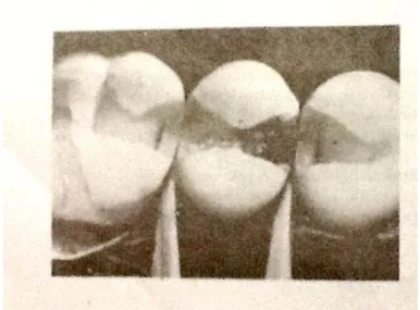 Gambar 5. Memotong lesi tengah melalui permukaan proksimal dari tiga  gigi