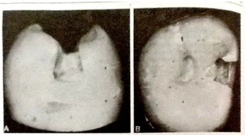 Gambar 6. Pandangan mesial dan oklusal dari preparasi gigi dengan lesi  karies insipien.