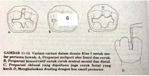Gambar 3.Premolar kanan bawah ; gambar kiri, benar ; gambar kanan, kesalahan  yang umum dilakukan.