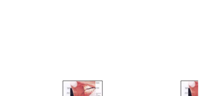 Gambar 2 :  View of the buccal and labial mucosa of the oral cavity with landmarks  Noted while being palpated  during an intraoral examination.