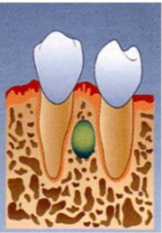 Gambar 1. Gambar Ilustrasi kista periodontal lateralis