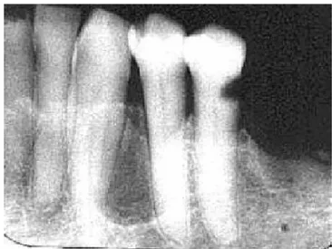 Gambar 2. Gambaran Radiografi kista periodontal lateralis C. Diagnosis