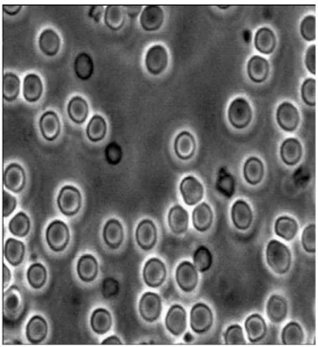 Gambar  6.  Gambaran  mikroskopik  sedimen  urin  memperlihatkan  gambaran  khas  pada  hematuria  glomerular:  sel  darah  merah  kecil  dan  bervariasi  dalam  bentuk,  ukuran,  dan  kandungan hemoglobin