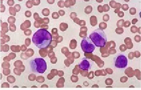 Gambar 2. Leukemia Mielositik Akut