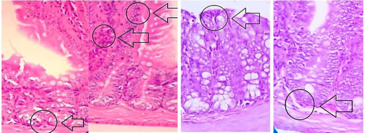 Gambar 2. Perbandingan infiltrasi sel radang pada kelompok dosis ekstrak Ipomoea batatas L.: (A) 0.21 g/kg  bb/hari, infiltrasi sel radang sampai ke lapisan submukosa duodenum (derajat 3)
