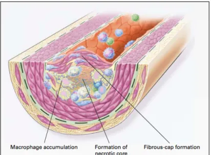 Gambar 2.6 Fibrous cap. 24