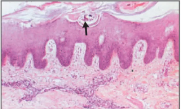 Gambar 12. Sarcoptes scabiei dalam epidermis (panah) dengan pewarnaan H.E  6. Uji tetrasiklin