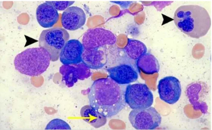 Gambar 9. Sel Megaloblast pada Anemia Megaloblastik 