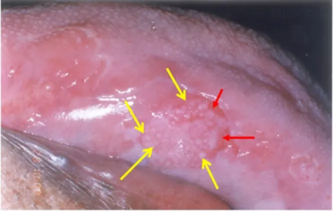 Gambar 6. Leukoplakia Nodular 13