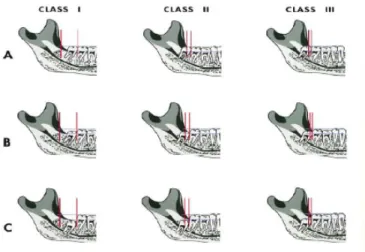 Gambar 3. Klasifikasi impaksi gigi ketiga menurut Pell &amp; Gregory 17