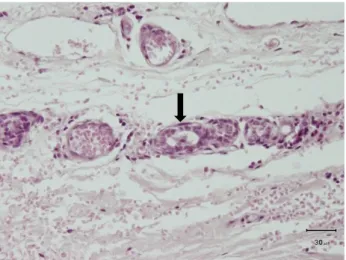 Gambar 1. Metastase sel-sel tumor dari Mix Malignant kelenjar mammae ditemukan adanya  sel  tumor  pada  pembuluh  darah  (H&amp;E,  400x),  ditandai  dengan  satu  atau  dua  lapis  otot  polos