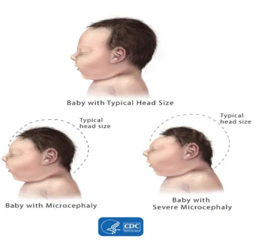 Gambar 2.2     Gambaran perbedaan kepala bayi normal – mikrosefali – mikrosefali berat