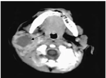 Gambar 1. CT-Scan pada parotitis supuratif, gambaran hipodensitas (anak panah) 9