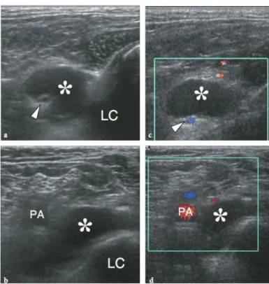 Gambar   8.   Ganglion   cyst.   USG   gray   scale   12–5   MHz   a   Longitudinal     b transversal   pada   aspek   eposteromedial   lutut   memperlihatkan   masa   kistik   batas tegas   (asterisk   yang   bedekatan   dengan   kondilus   lateralis   (L