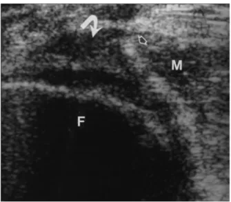 Gambar  10. Laki-laki  25 tahun tanpa gejala.  USG transversal memperlihatkan gambaran   tendon   semmembranosus   (   panah   solid)   dan   tendon   gastrocnemius medial (panah terbuka) tanpa cairan
