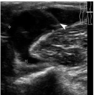 Gambar 12. A USG transversal memperlihatkan Baker’s cyst dengan  Proliferasi  synovial and  septasi internal (kepala panah)
