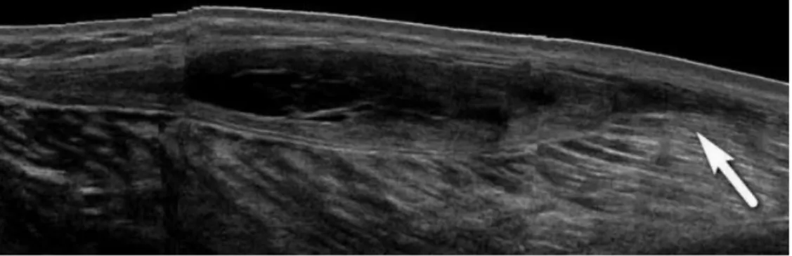 Gambar 15. Baker’s cys dengan leakage. A. USG longitudinal memperlihatkan  Baker’s cyst dengan jung yang  tajam menunjukkan  adanya ruptur Baker’s cyst,