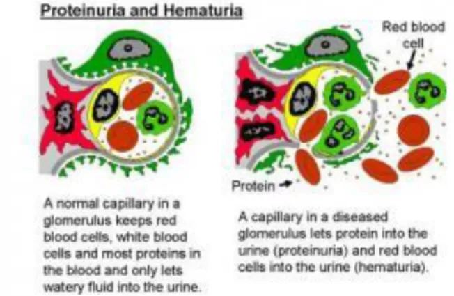 Gambar 7.proses terjadinya proteinuria dan hematuria 