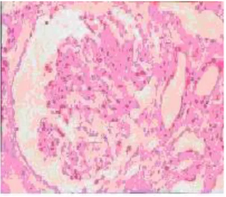 Gambar 8. Histopatologi gelomerulonefritis dengan mikroskop cahaya pembesaran  20× 